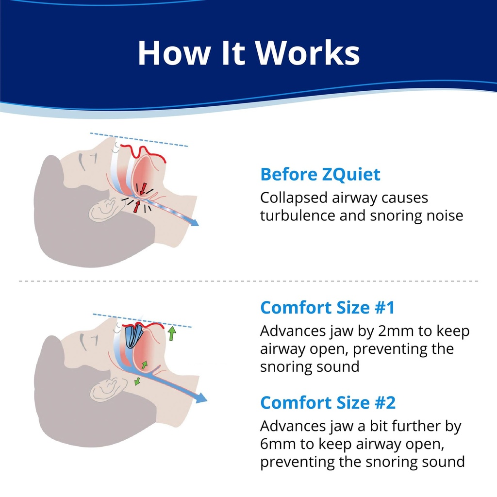 zquiet-anti-snoring-mouthpiece-blue-clea-2.jpg