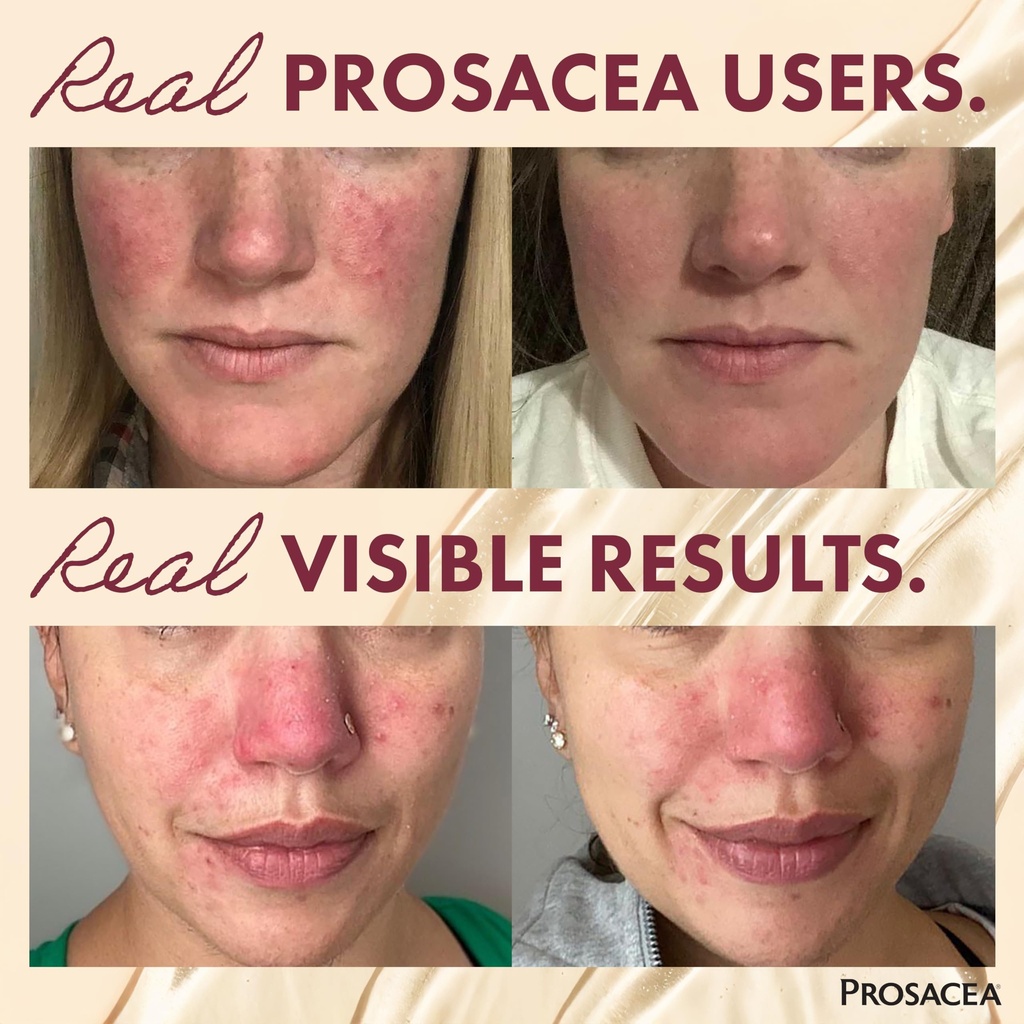 prosacea-medicated-rosacea-treatment-for-4.jpg