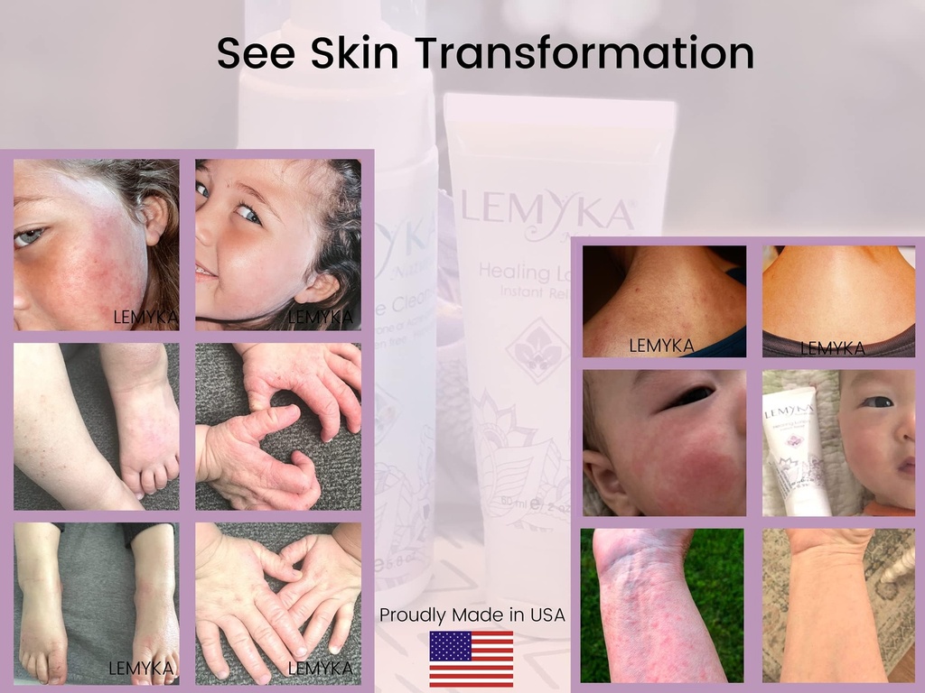 rosacea-cream-face-redness-relief-facial-5.jpg