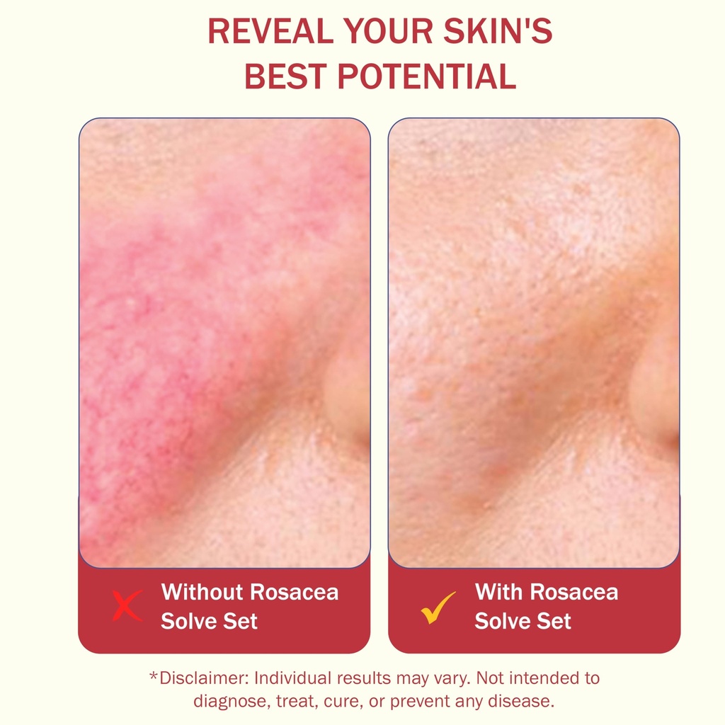 healfast-rosacea-set-includes-rosacea-cr-5.jpg