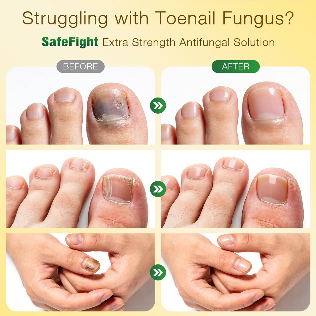 toenail-fungus-treatment-with-25-undecyl-5.jpg