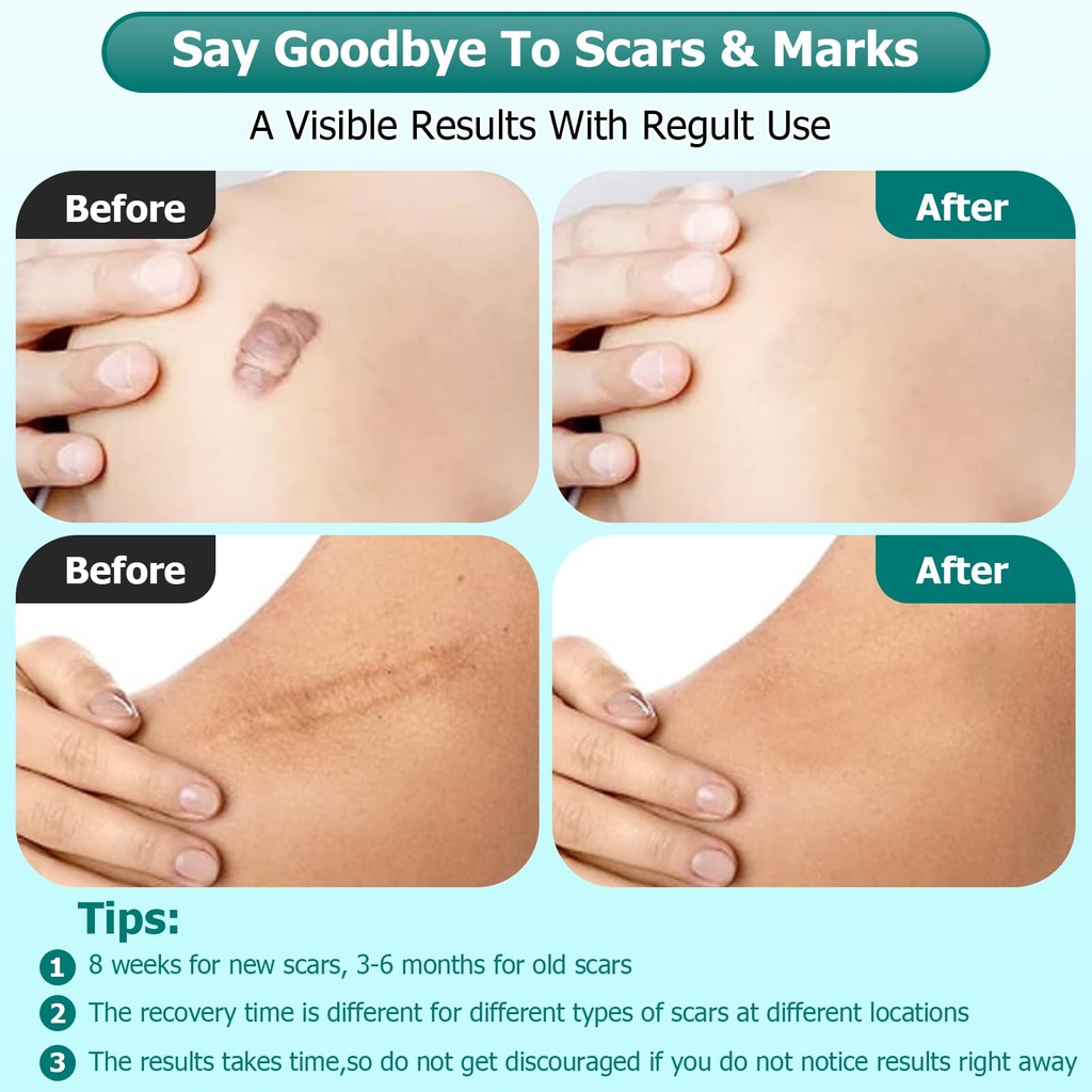 gowgaw-scar-gel-scar-cream-advance-scar--4.jpg