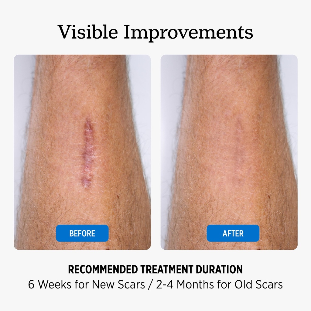 nuvadermis-silicone-scar-sheets-extra-lo-5.jpg