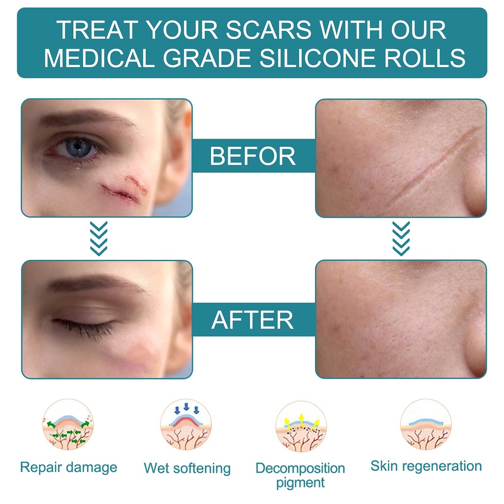medical-grade-silicone-scar-sheets-silic-3.jpg