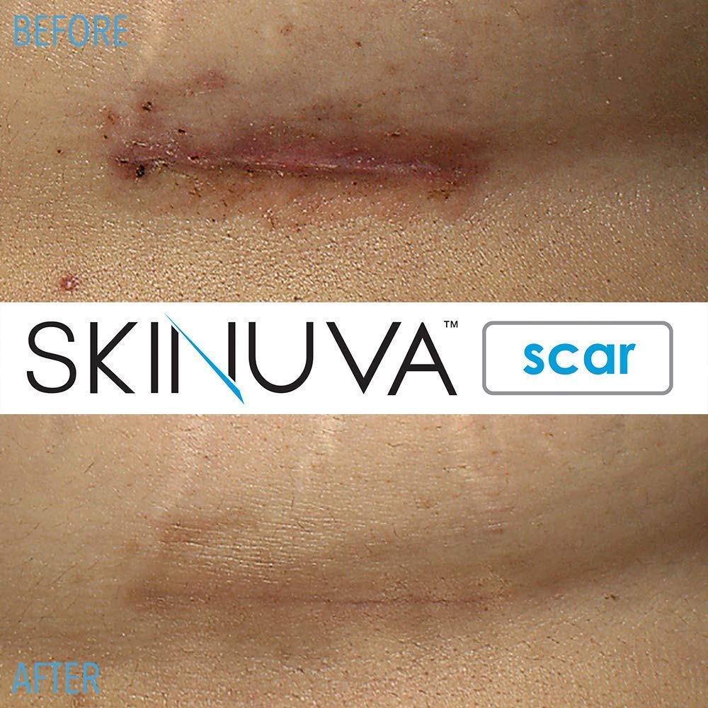 skinuva-scar-cream-for-face-body-1-oz-he-6.jpg