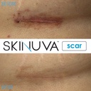 skinuva-scar-cream-for-face-body-1-oz-he-6.jpg