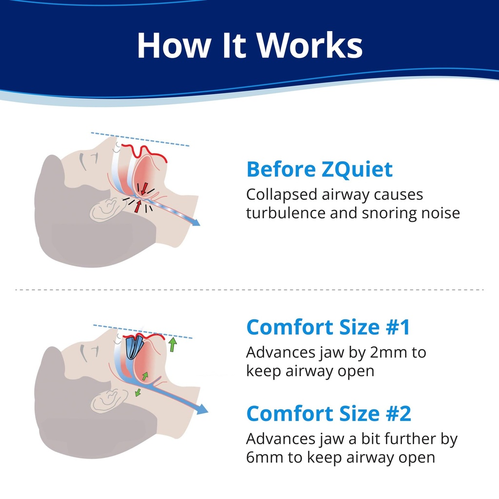 zquiet-anti-snoring-mouthpiece-2-size-st-3.jpg