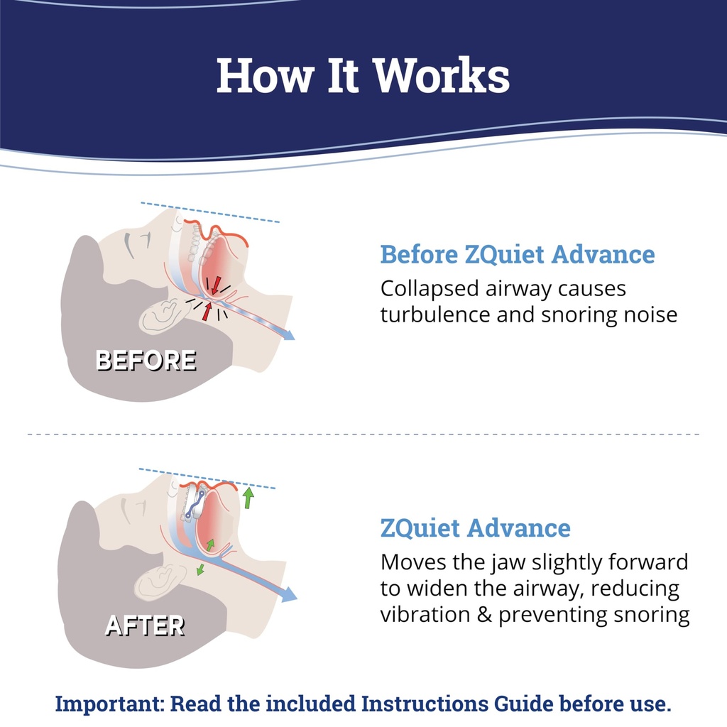 zquiet-advance-custom-anti-snoring-mouth-2.jpg