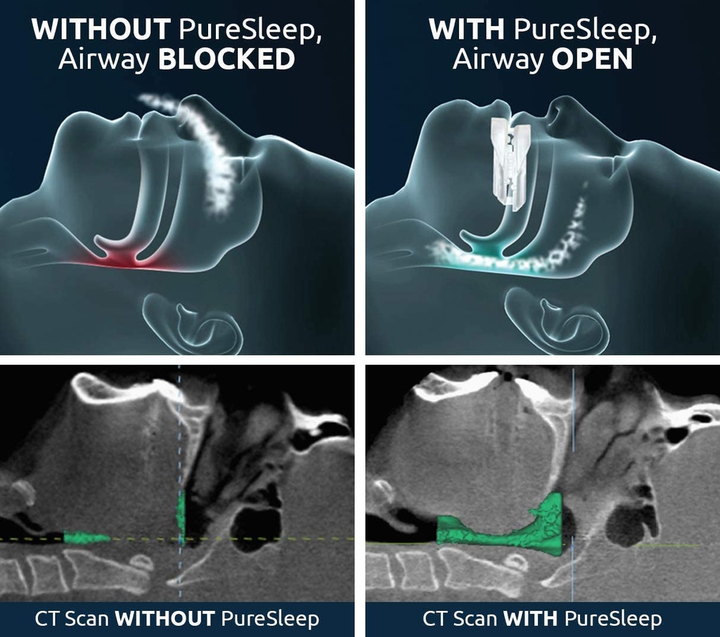 bundle-puresleep-anti-snoring-mouthpiece-4.jpg