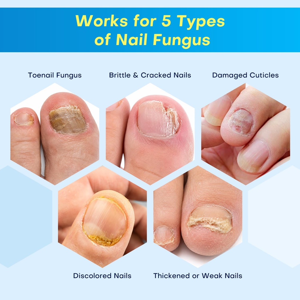 nail-fungus-treatment-pen-for-damaged-na-3.jpg