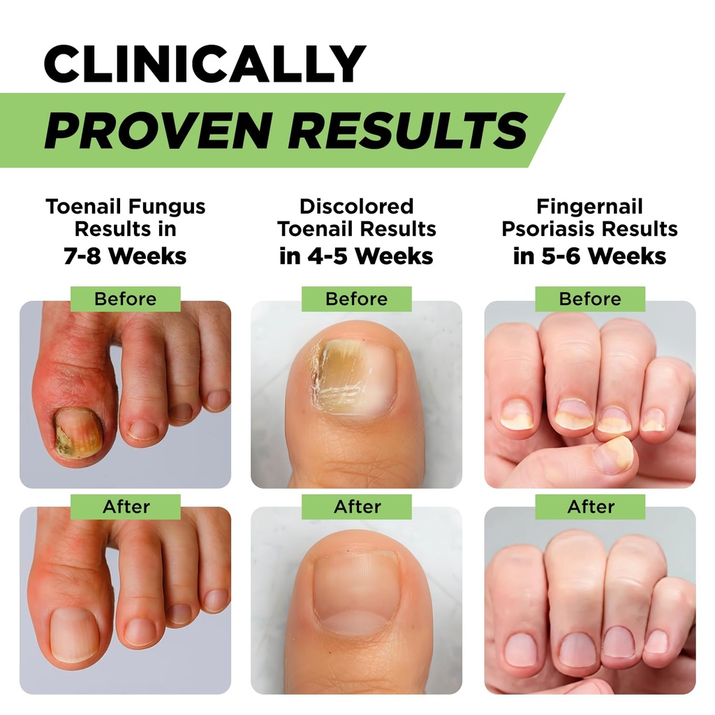 footcure-antifungal-nail-treatment-pen-e-4.jpg