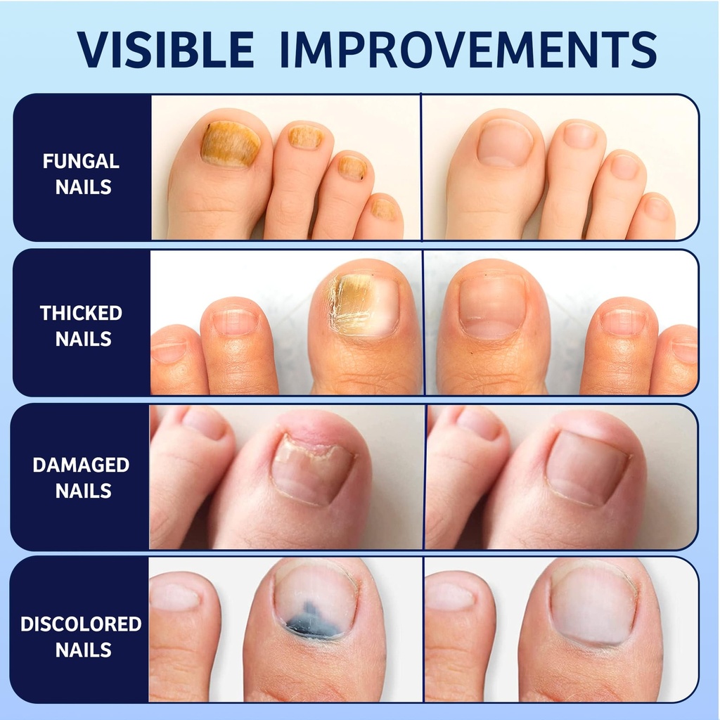 toenail-fungus-treatment-extra-strength--5.jpg