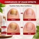 2pcs-fungi-nail-toenailtreatment-gentle--5.jpg