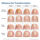 vrenmol-toenail-fungus-treatment-extra-s-5.jpg
