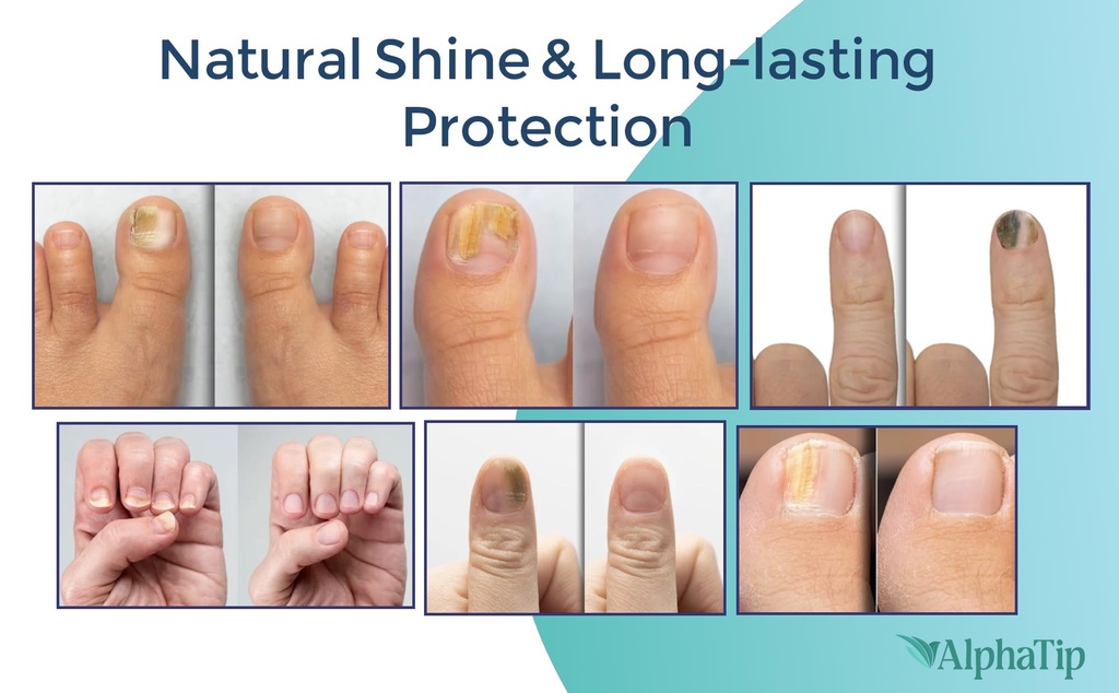 nail-fungus-treatment-pen-nail-repair-an-5.jpg