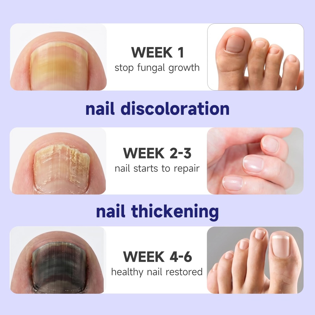 fingernails-toenail-fungus-treatment-ext-2.jpg