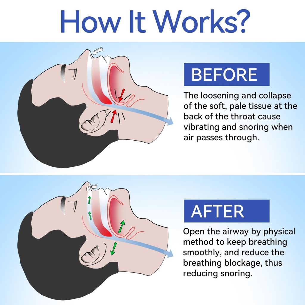 anti-snoring-devices-anngola-snoring-sol-2.jpg