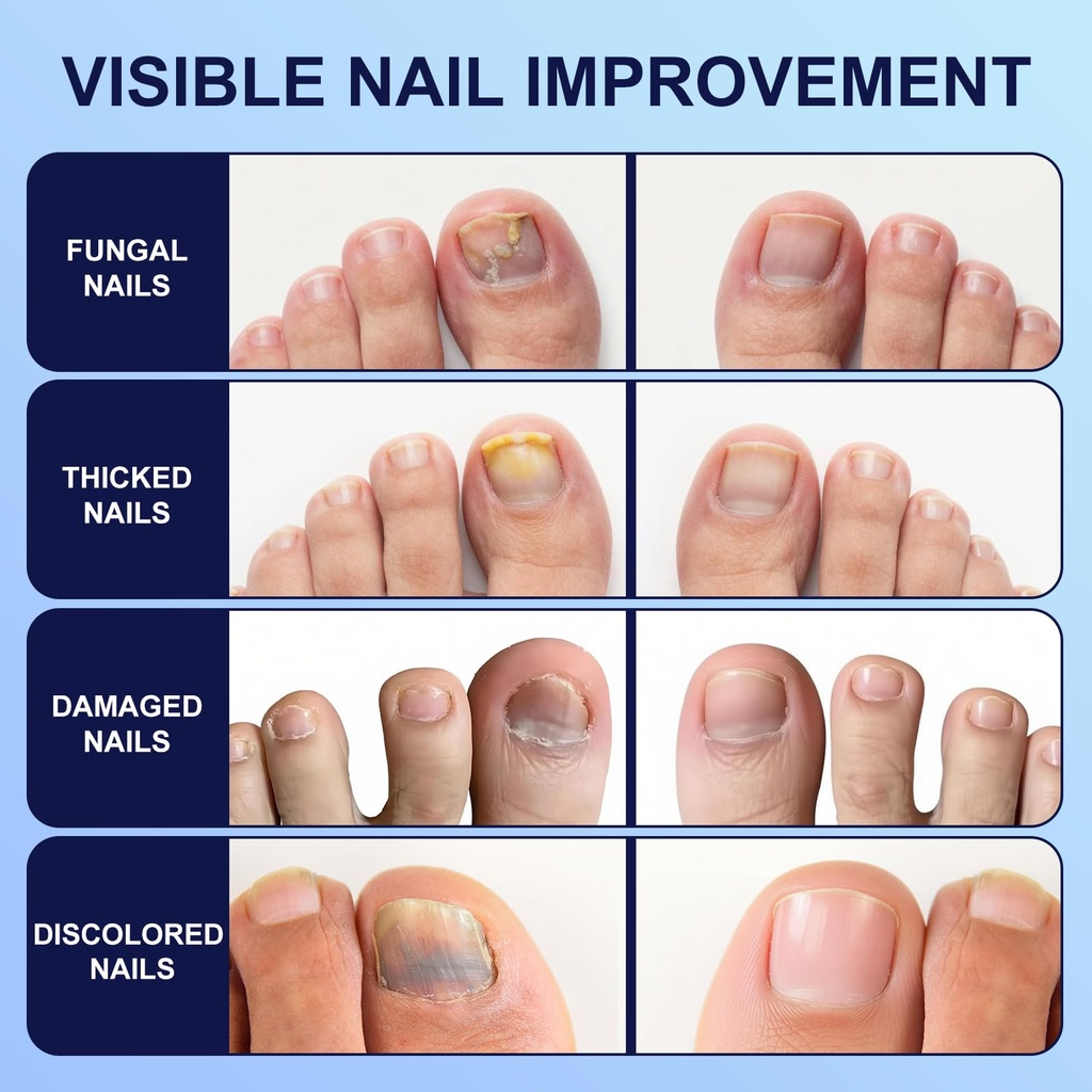 toenail-fungus-treatment-extra-strength--3.jpg
