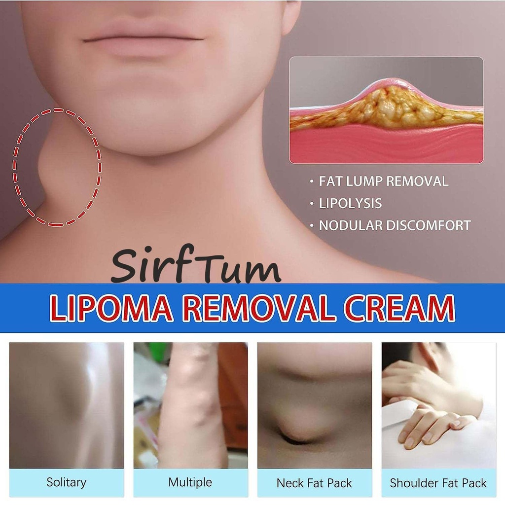 lipoma-removal-cream-mild-easy-to-use-ca-71aymZ3Ij5L.jpg
