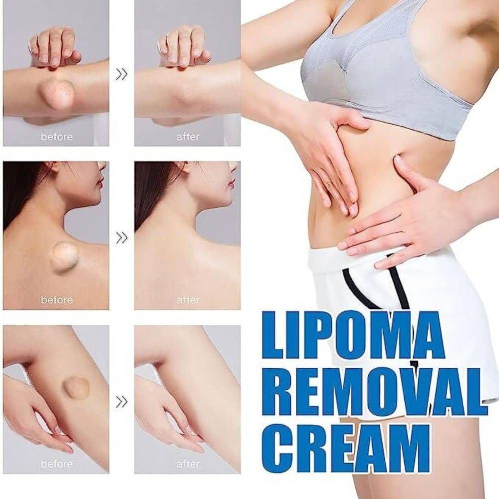 lipoma-removal-cream-whole-body-lipoma-l-61DlB1K-h1L.jpg