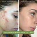 sonya-dakar-blemish-buster---acne-spot-t-5.jpg