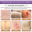 silicone-scar-sheets-silicone-scar-tape--2.jpg