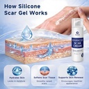 rvlaim-silicone-scar-cream-scar-gel-adva-4.jpg