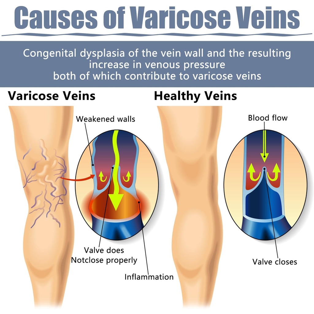36pcs-varicose-veins-patch-natural-relie-5.jpg