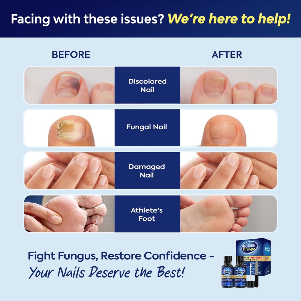toenail-fungus-treatment-with-25-undecyl-3.jpg
