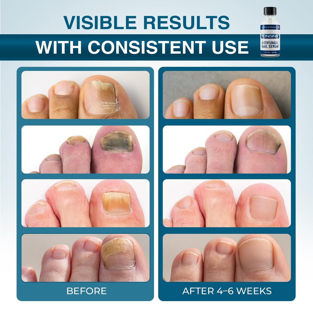 funginix-fungus-treatment-toe-fungus-fin-3.jpg