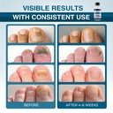 funginix-fungus-treatment-toe-fungus-fin-3.jpg