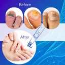 nail-fungus-pen-for-toenails-fingernails-5.jpg