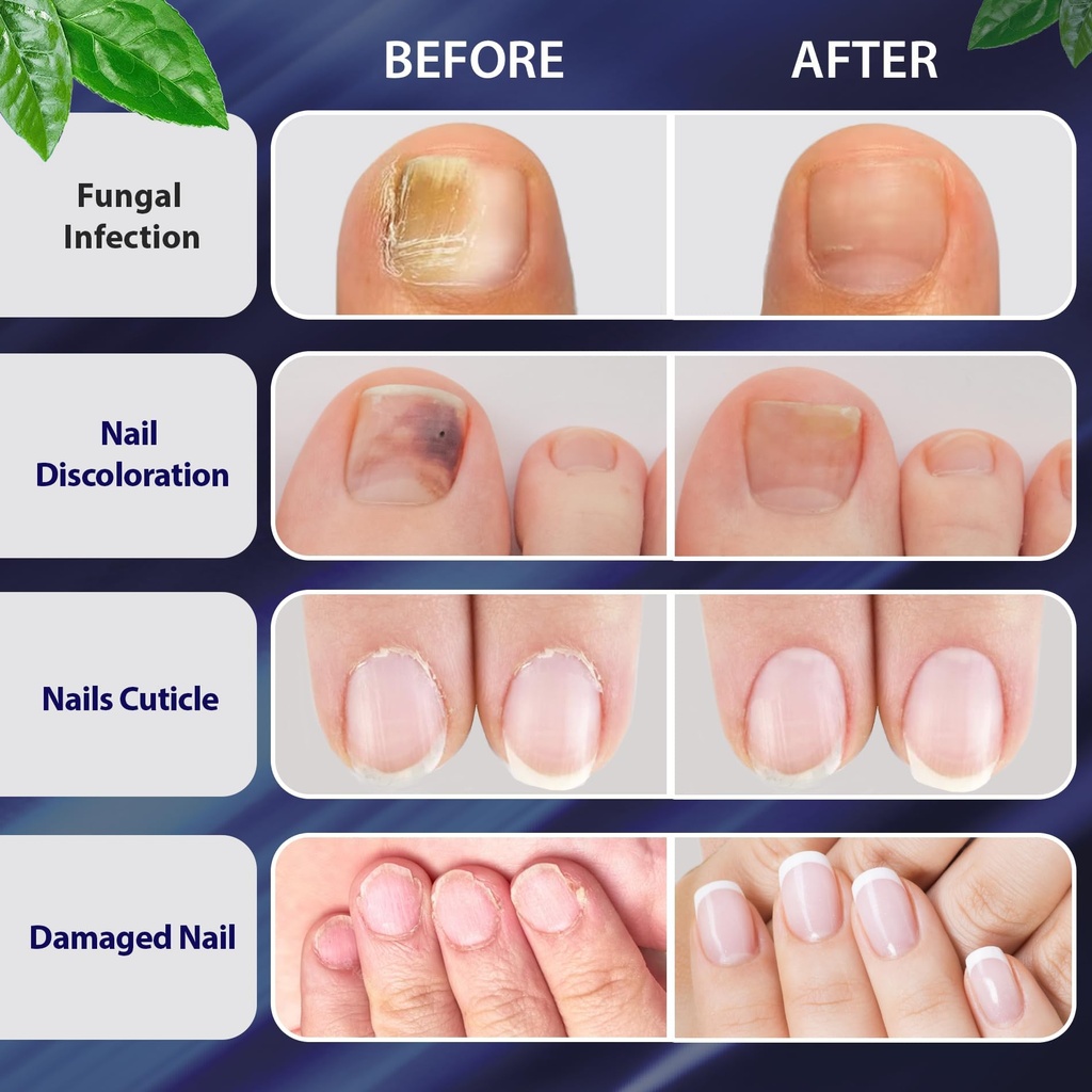 tobcharm-toenail-fungus-treatment-nail-f-4.jpg