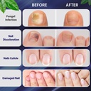 tobcharm-toenail-fungus-treatment-nail-f-4.jpg