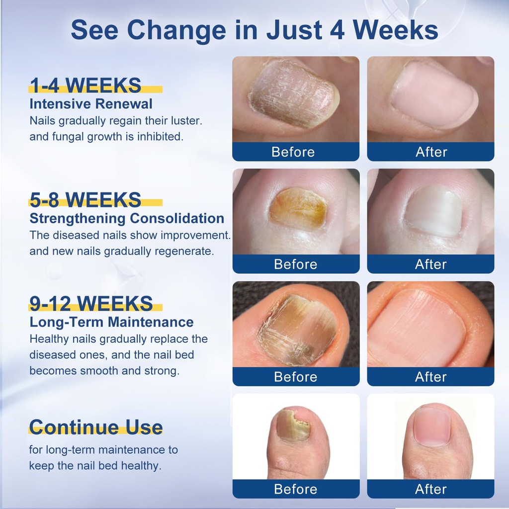 toenail-fungi-treatment-extra-strength-f-4.jpg
