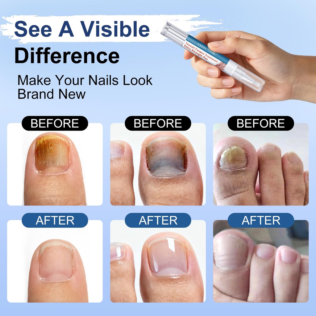 toenail-fungus-treatment-extra-strength--4.jpg