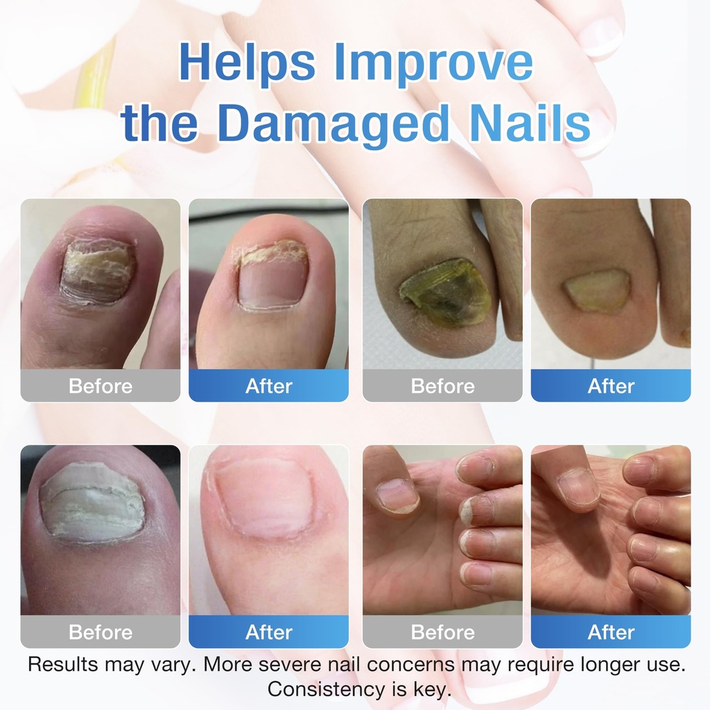 toenail-fungus-treatment-extra-strength--5.jpg