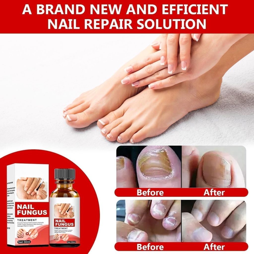 toenail-fungus-treatment-extra-strength--5.jpg