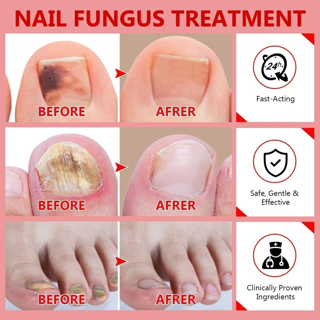 toenail-fungus-treatment-extra-strength--6.jpg