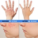 sugar-free-eczema-treatment-gummies-usa--3.jpg