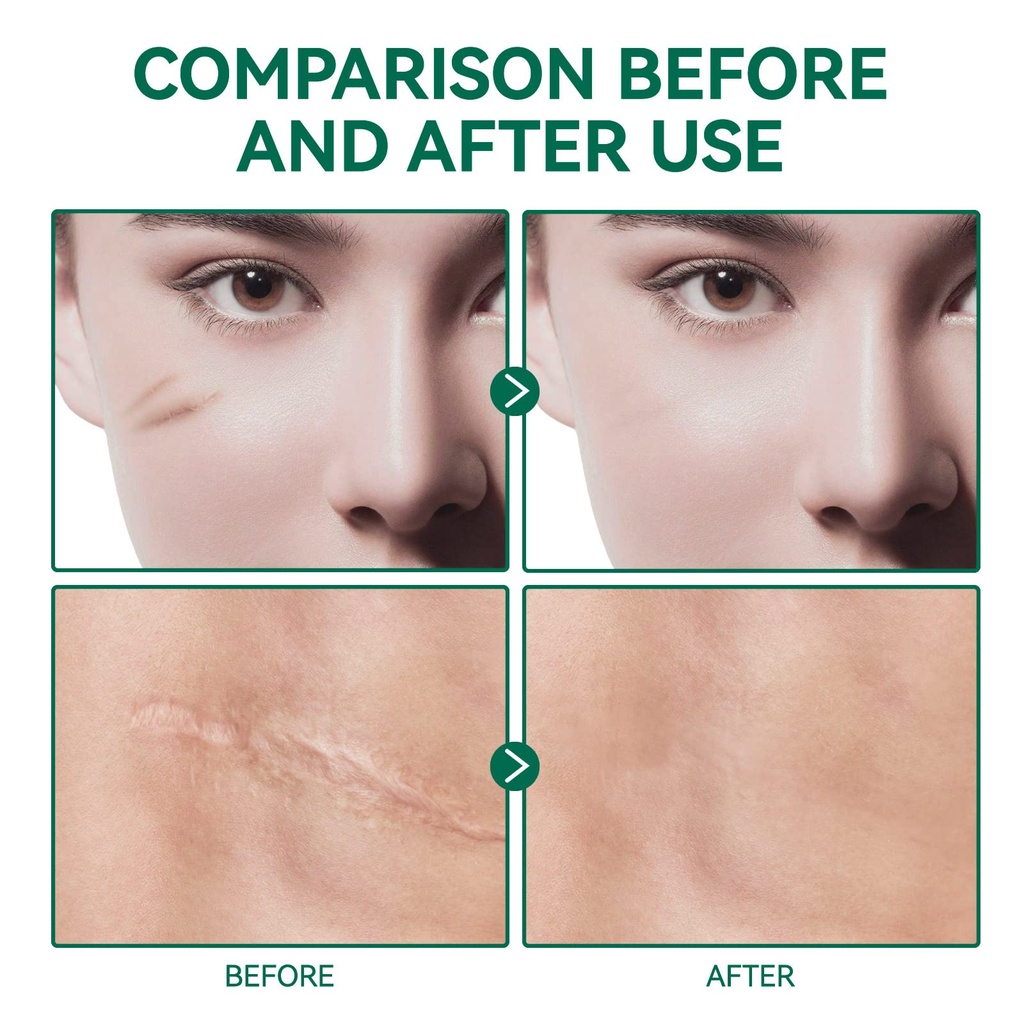 scar-gel-scar-removal-cream-scar-treatme-5.jpg