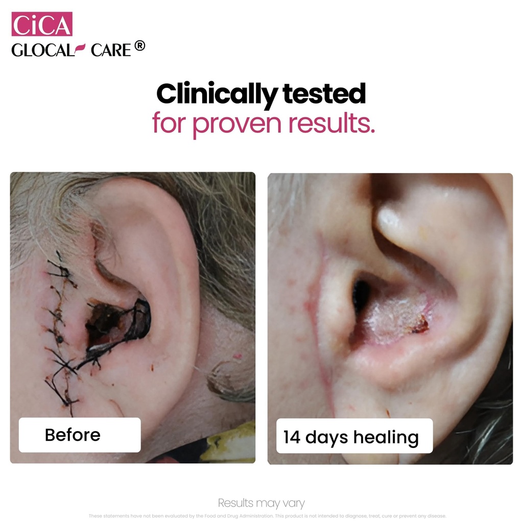 cica-glocalcare-clinical-grade-skin-reco-6.jpg