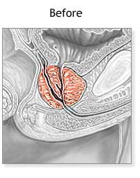 pulean-formula-natural-enlarged-prostate-5.jpg