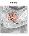 pulean-formula-natural-enlarged-prostate-5.jpg