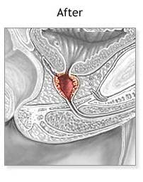 pulean-formula-natural-enlarged-prostate-6.jpg