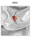 pulean-formula-natural-enlarged-prostate-6.jpg