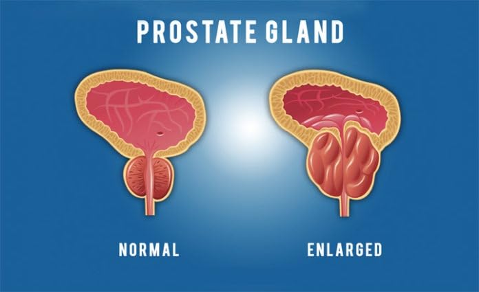 pulean-formula-natural-enlarged-prostate-4.jpg