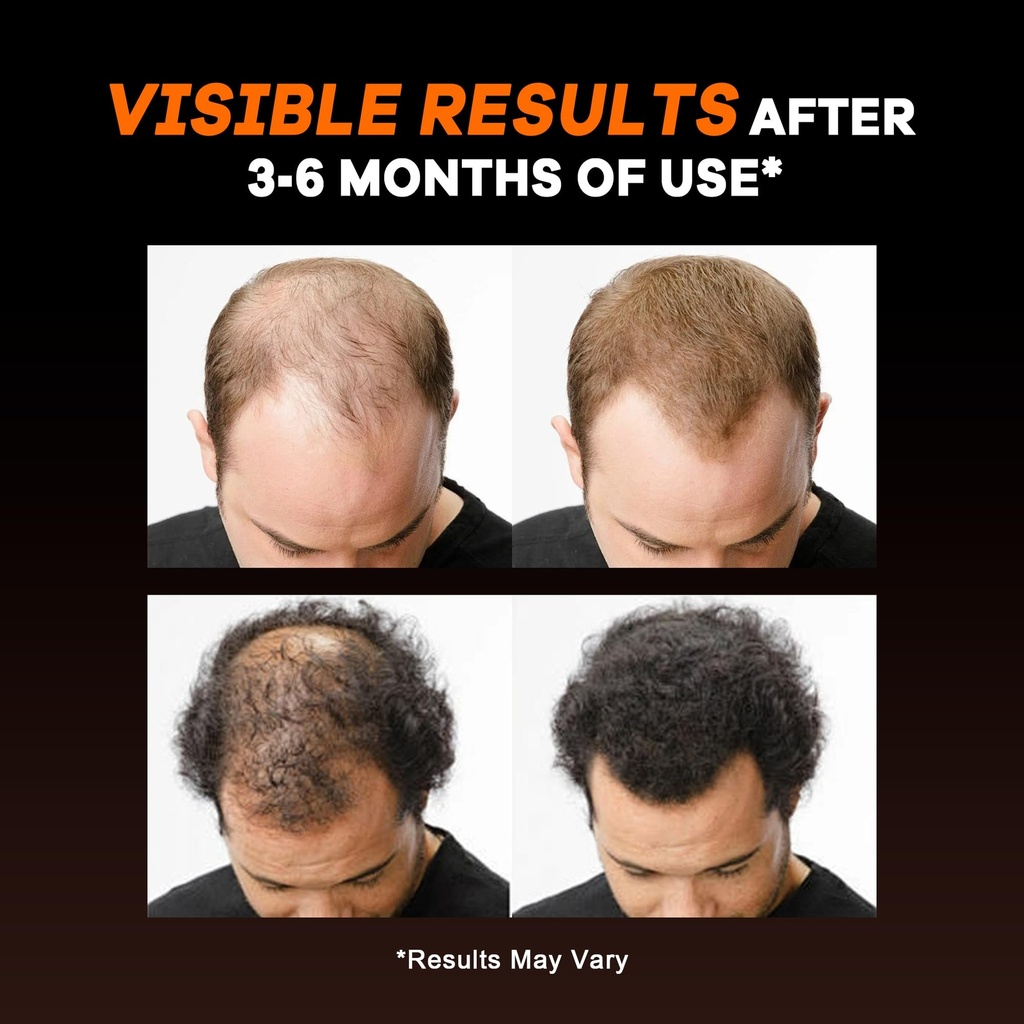 dht-blocker-for-men-hair-growth-natural--3.jpg