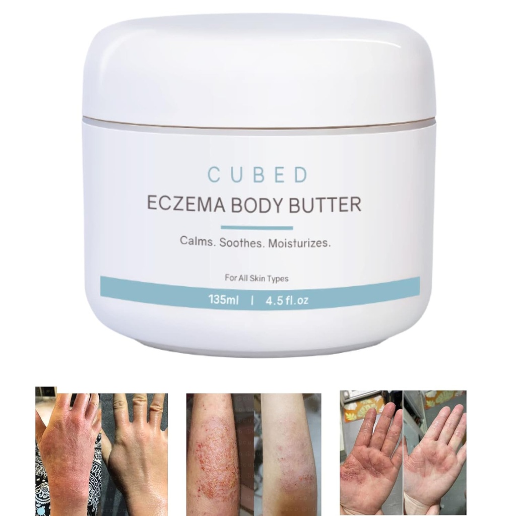 Eczema creme de 4,5 oz para adultos, alívio de Eczema, tratamento de Eczema, hidratar a pele seca irritada, Smart Lotion para sintomas tópicos de abstinência de esteroides, Psoríase & Rosacea, Eczema, Dermatite