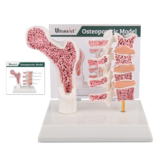 [BRSROYI7OUPAE2AV] Ultrassist Human Anatomy Osteoporosis Model, Vertebrae Anatomical Skeleton Model with Study Card for Medical Student Teaching Demonstration